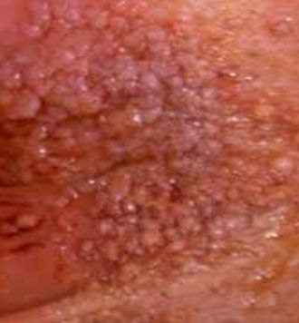 HPV Lezyonları