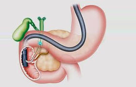 ERCP