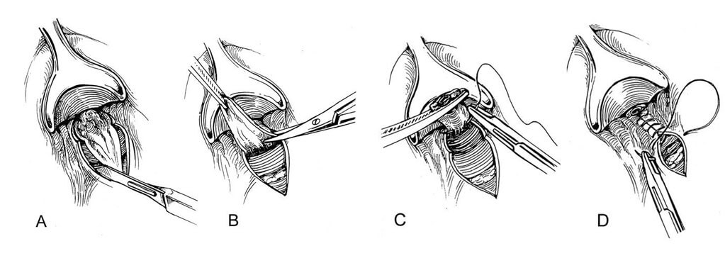 Ameliyat ile hemoroid tedavisi