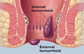 Hemoroid