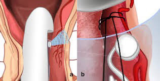 Doppler ile hemoroid tedavisi