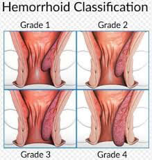 Hemoroid dereceleri