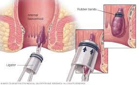 Hemoroid RBL Tedavisi