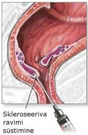 Skleroterapi ile hemoroid tedavisi