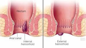 Hemoroid Tipleri