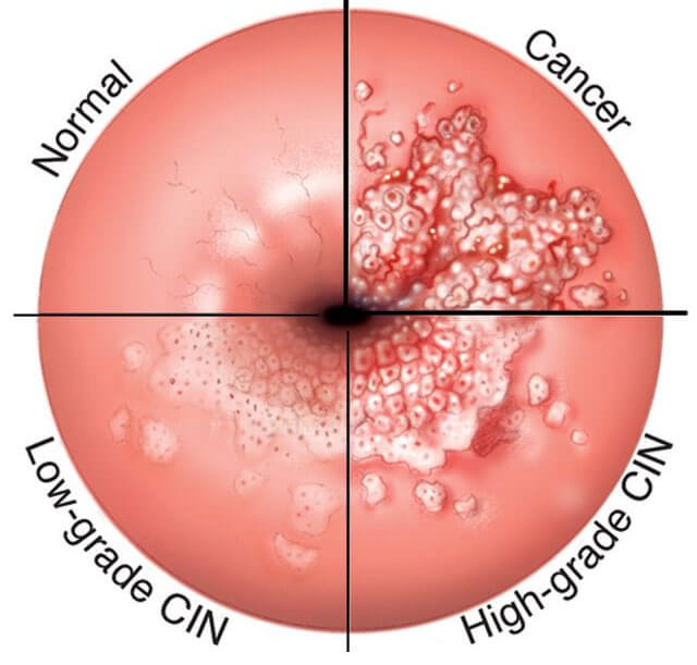 HPV Kanser Riski İçerir