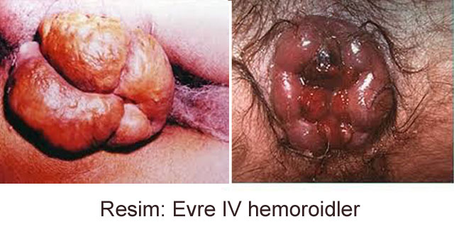 4. Evre Hemoroid hastalığı