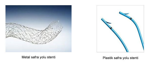 Safra yolu stent çeşitleri