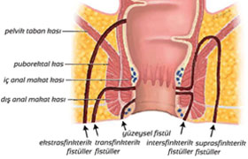 Perianal fistül