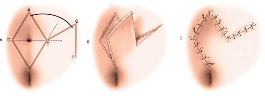 Romboid flap tekniği