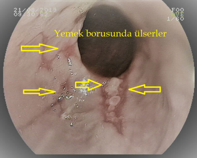 Yemek borusunda reflüye bağlı ülser gelişimi