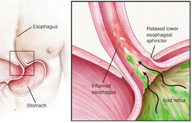 Gastroözefageal reflü