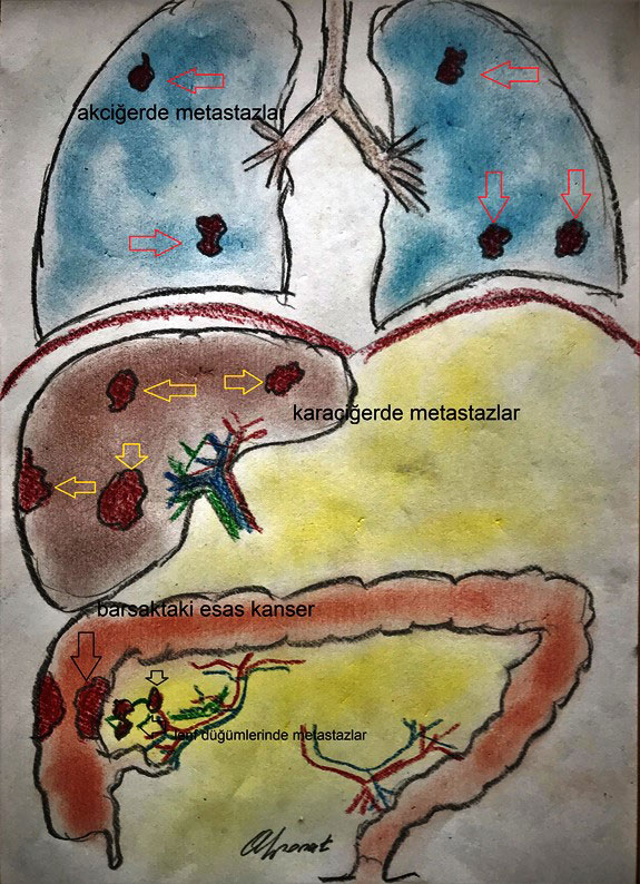 Kanserli hücrelerin yayılması