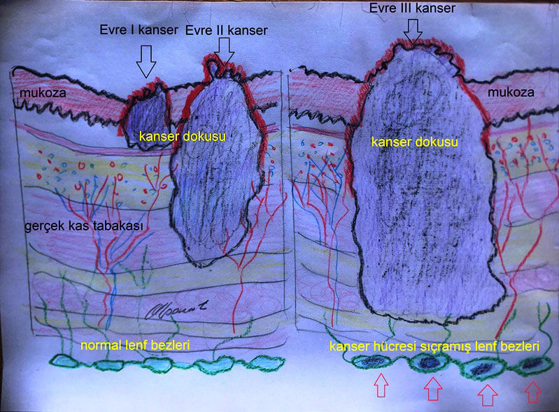 Kanserin evreleri ve yayılma şekli