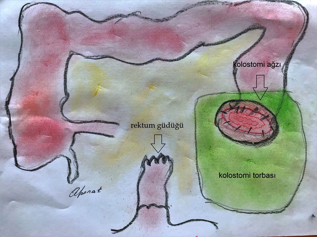 kolon kanseri olan hastalarda kolostomi uygulaması