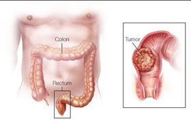 Rektum kanseri