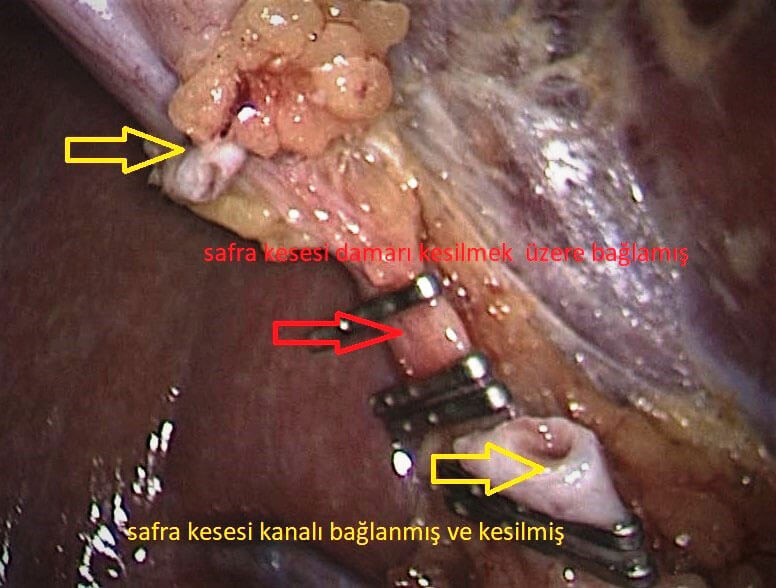 Safra kesesi ameliyatı