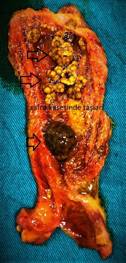 Safra kesesi taşları görüntüsü