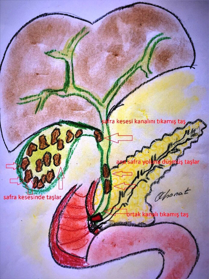 Safra kesesinde taşların görünümü